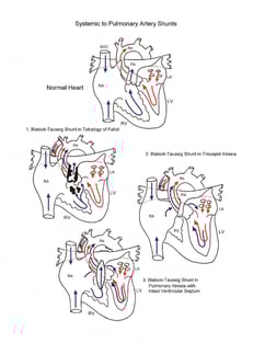 Systemic to Pulmonary Artery Shunts illustration