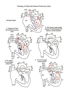 Tetralogy of Fallot with Absent Pulmonary Valve illustration