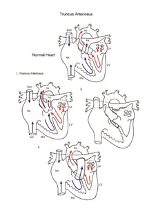 Truncus Arteriosus illustration