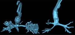 3D image of tracheal agenesis