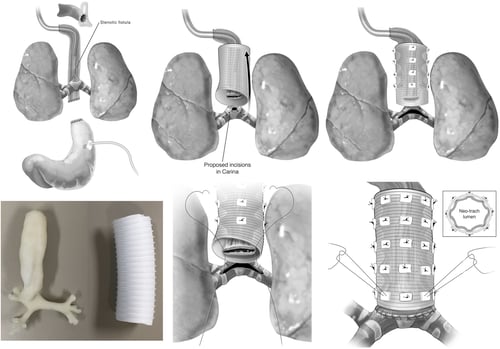 Process of placing tracheal tube 
