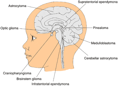 Diagram of the different types of brain tumors