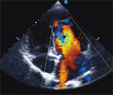 Photo of Pulmonary Hypertension