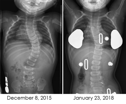 X-rays of torso