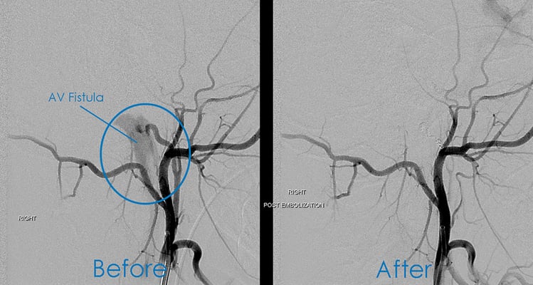 Toby's AV Fistula before and after surgery