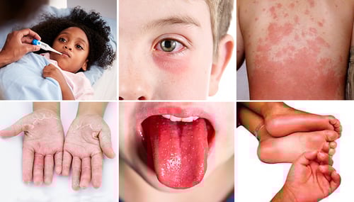 COVID-19 Pediatric Inflammatory Multisystem Syndrome PIMS Children's Wisconsin