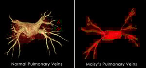 Diagram of normal pulmonary veins compared to pulmonary vein stenosis.