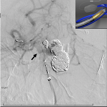  Angiogram showing deployment of pipeline flow diverter stent across the top of the basilar artery (arrow), with schematic inset (top right corner)