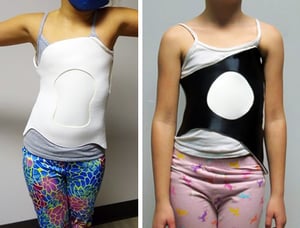 3D printed scoliosis brace orthopedic department Children's Wisconsin John Thometz, MD, Xue Cheng Liu, MD, PhD, 