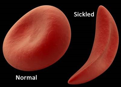 Sickle cell vs healthy red blood cell Children's Wisconsin 