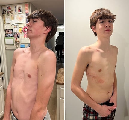 Jeb pectus excavatum sunken chest cryoanalgesia John Densmore, MD, pediatric surgeon, Children's Wisconsin