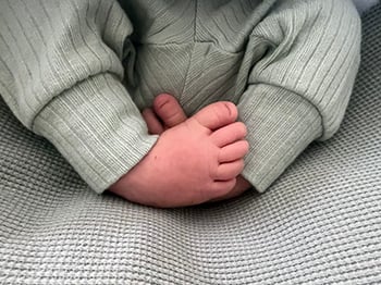 Clubfoot Children's Wisconsin Orthopedics Program