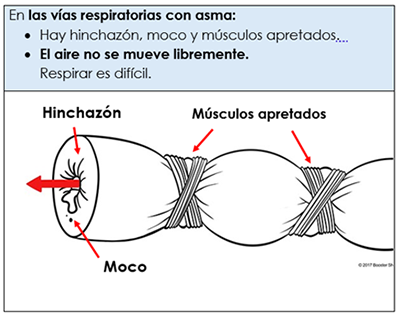 asthma airway