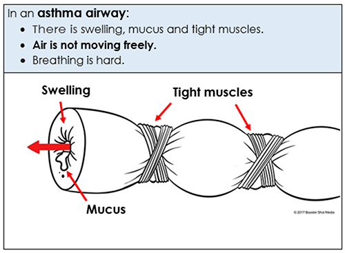 asthma airway
