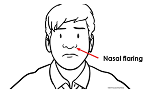nasal flaring