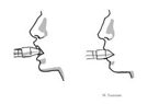 Nebulizer instruction 6
