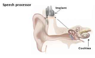 Ear implant