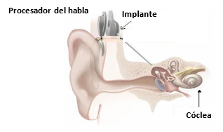 Ear implant