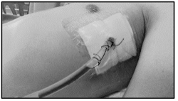 Man with a chest tube in his side