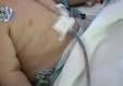 Child with tube in their side