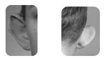 Prominent ear surgery