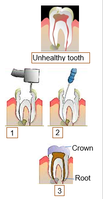Root canal