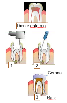 Root canal