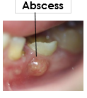 Abscess