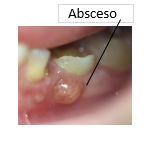 Absceso