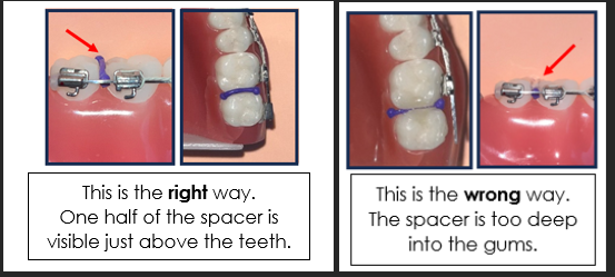 The right and wrong to place a tooth spacer