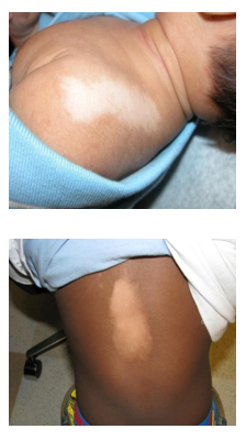 what is vitiligo