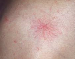 spider angioma