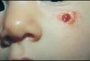 granuloma