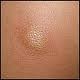 mastocytoma