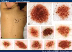 nevus