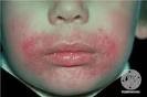 perioral