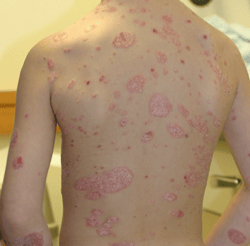 psoriasis