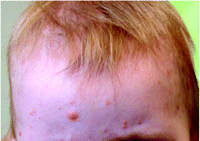 Xanthogranuloma