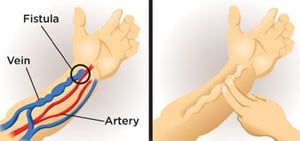 fistula