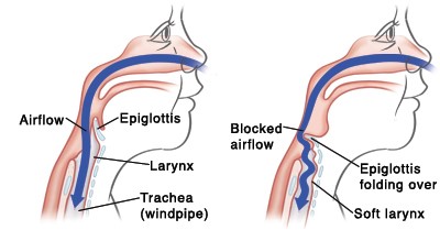 Laryngomalacia