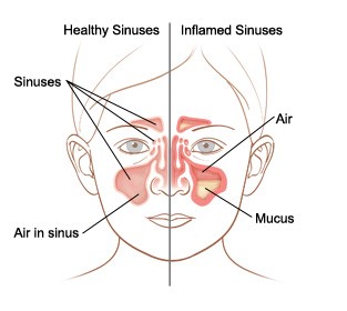 Sinuses