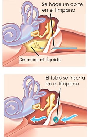 ear tubes
