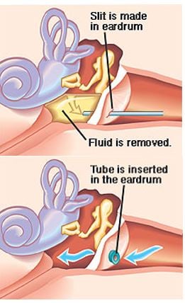 Ear tubes