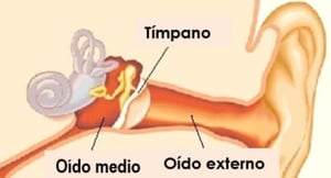 otitis media