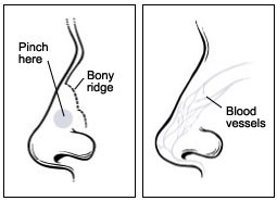 Stopping a nosebleed