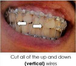 Cutting wires