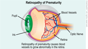 retinopathy