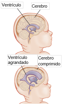 What is hydrocephalus