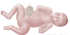 How do you treat gastroschisis