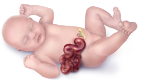 What is gastroschisis
